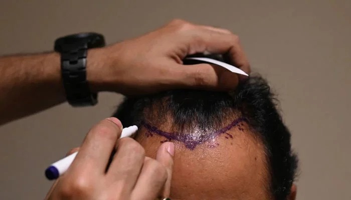 Hair Transplant Istanbul – Safe, Effective, and Pain-Free Solutions