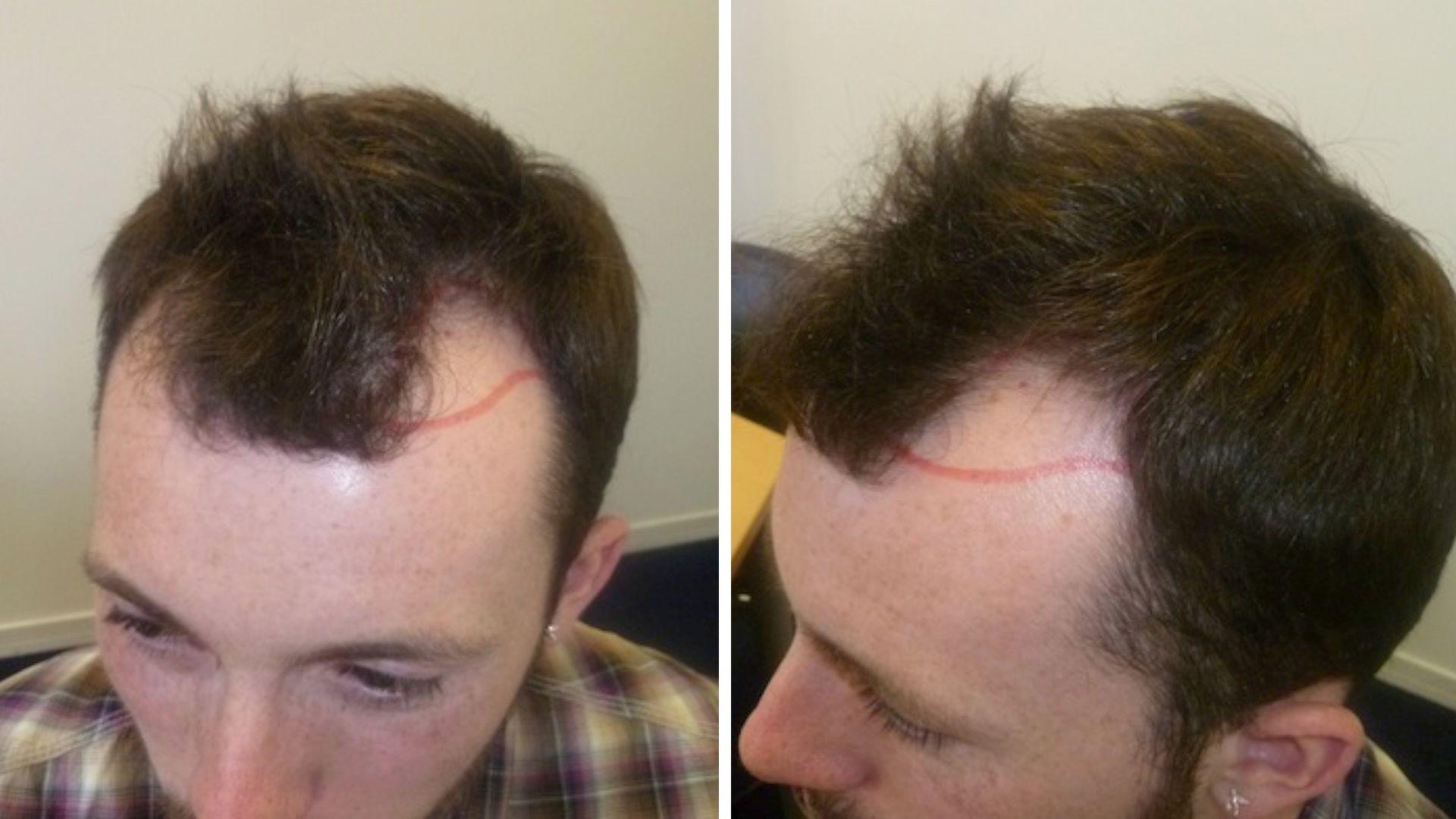 Choosing the Right Hair Transplant UK Clinic – What to Know