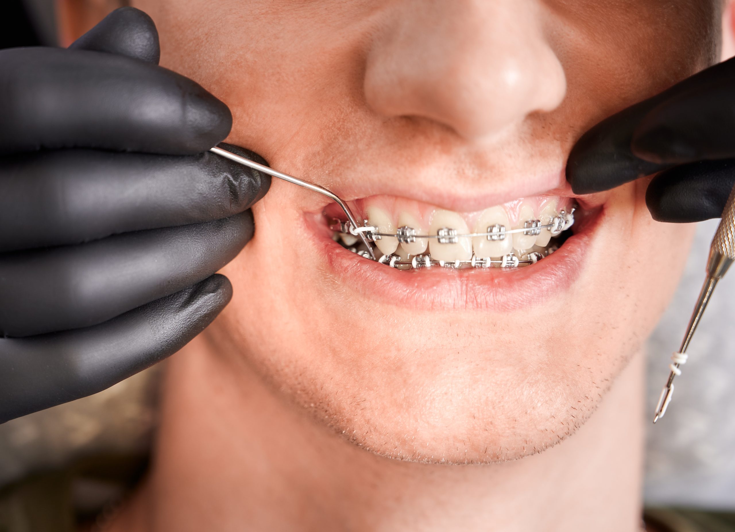 Finding the Right Orthodontist Near Me: A Comprehensive Guide